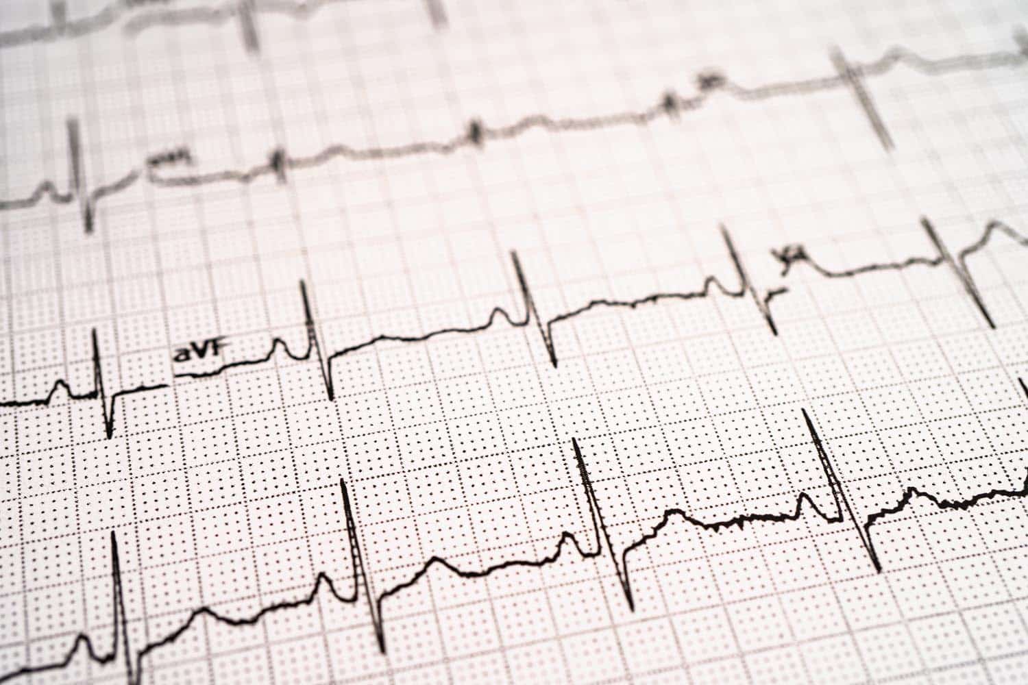 Close-up of an electrocardiogram (ECG or ECG) printout showing heart activity patterns on graph paper.