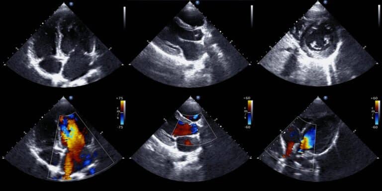 Six echocardiogram images showing various heart views, with the lower three displaying color Doppler to indicate blood flow direction and velocity.