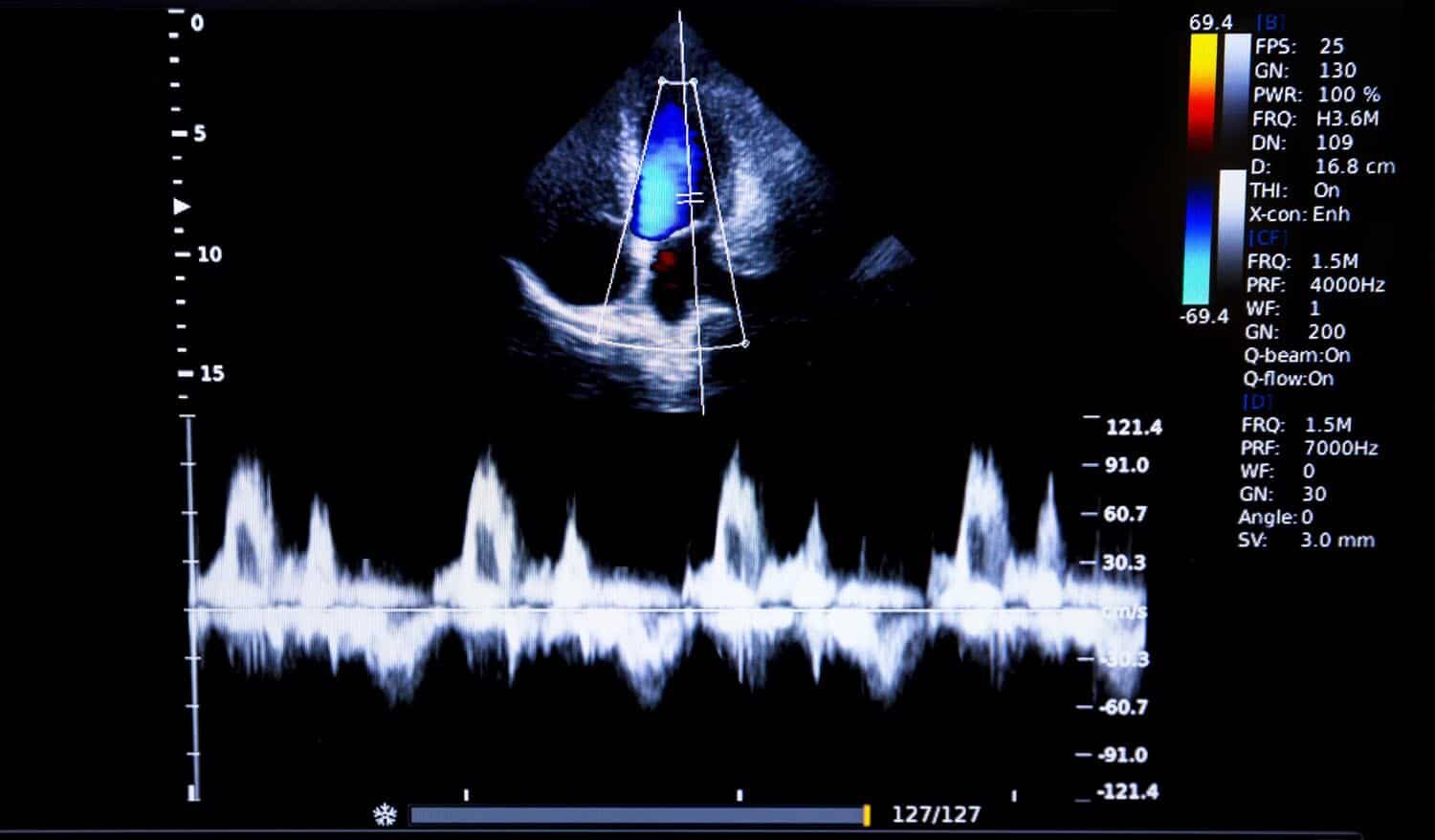 Echocardiograms