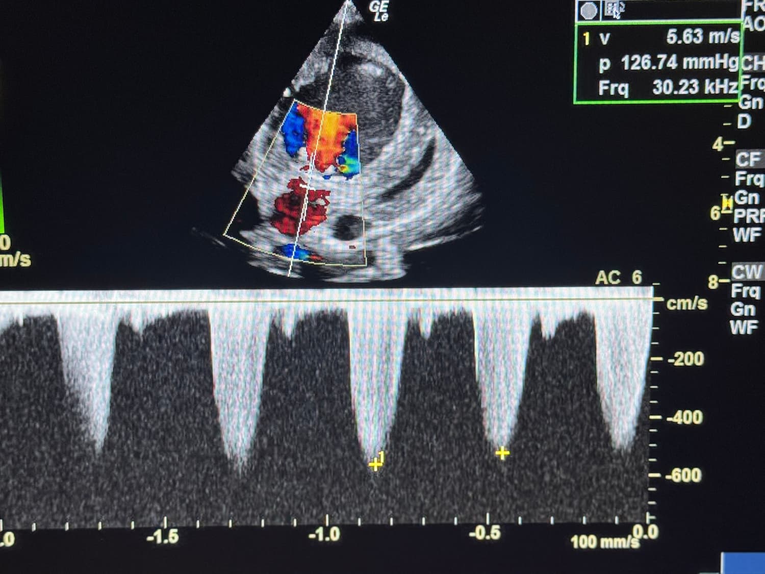 Echocardiogram image showing Doppler color flow and waveform tracings, displaying measurements of blood flow velocity through the heart.